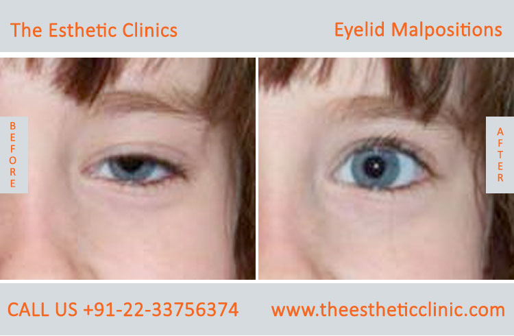 Eyelid Malpostions, Ectropion Entropion Surgery before after photos in mumbai india (4)